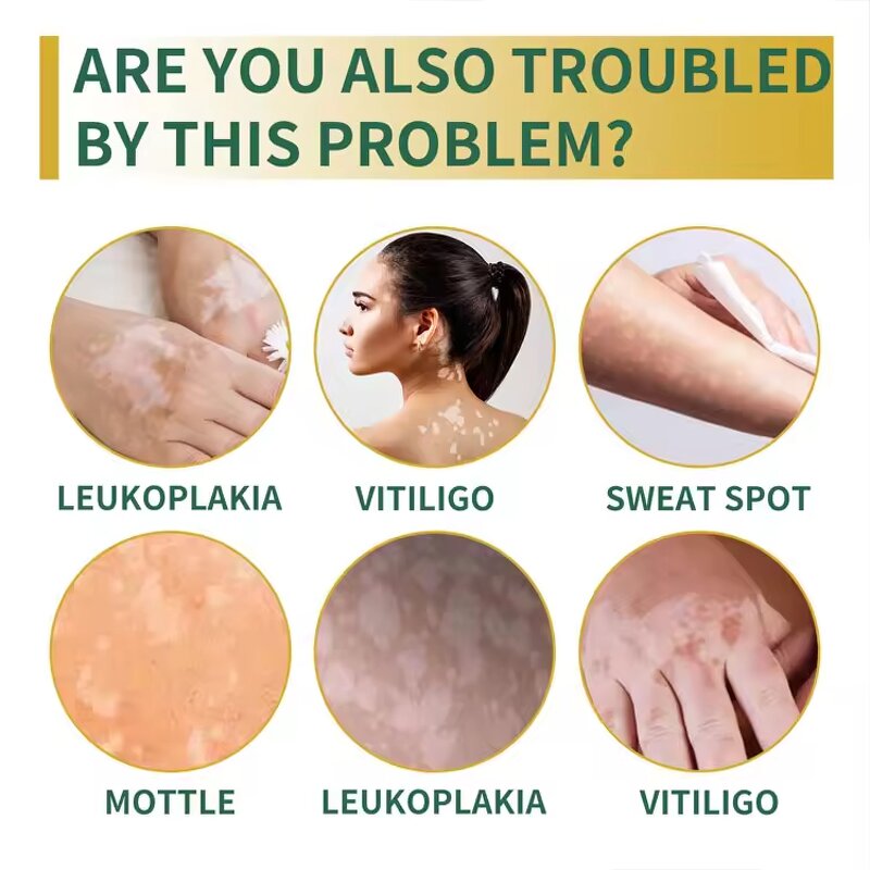 Vitiligo Treatment Ointment Manufacturer - Anti-Bacterial Psoriasis & Leukoplakia Plaster