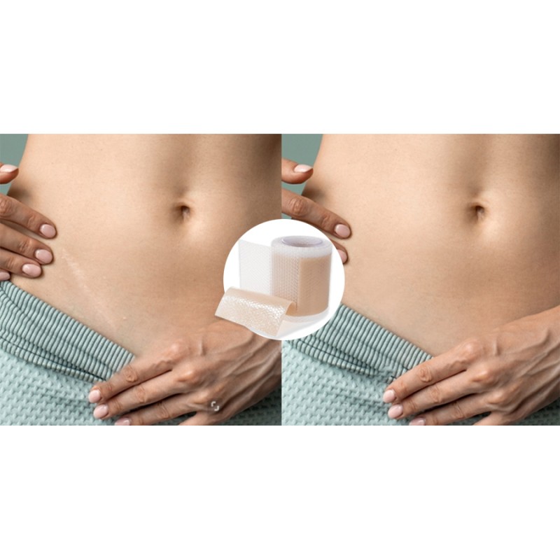 Scar Roll Supplier - Silicone Self-adhesive Waterproof
