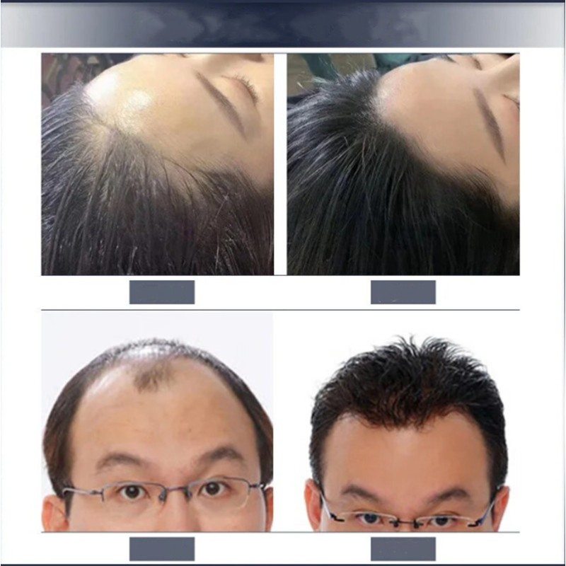 Hair Loss Solution Supplier - ZS EGF Anti-Aging Follicle Repair