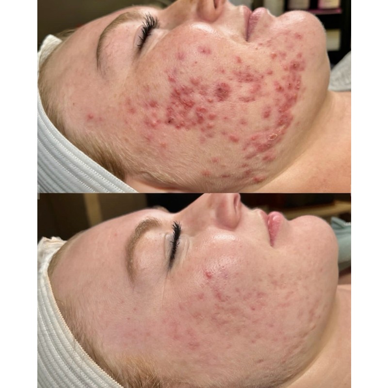 Microneedling Spicules Supplier - BIO Hyaluronic Acid Infused