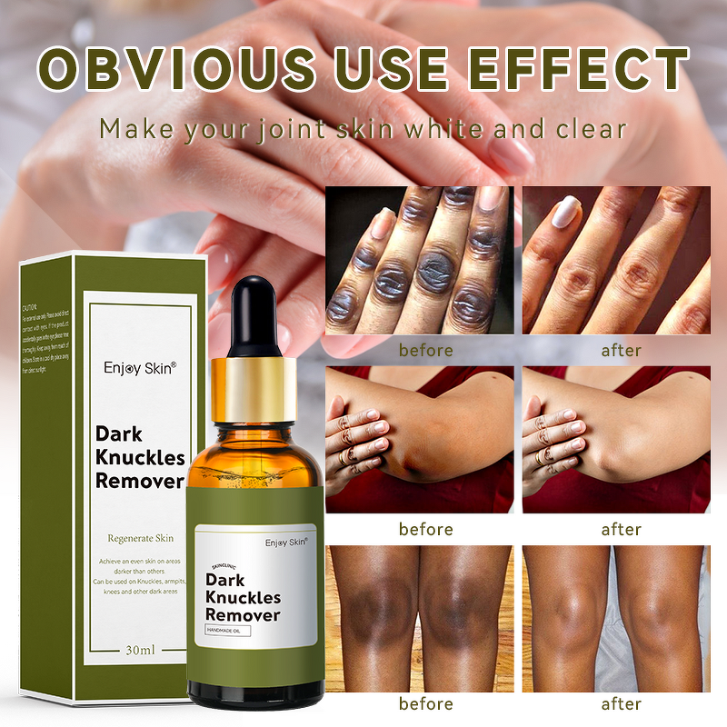 Skin Serum for Brightening & Evening Skin Tone - 30ml Disappear Dark Spots Serum