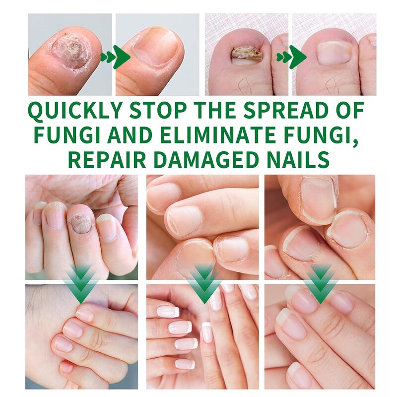Nail Fungus Cream Manufacturer - Plant Extract Formula for Repair & Hydration