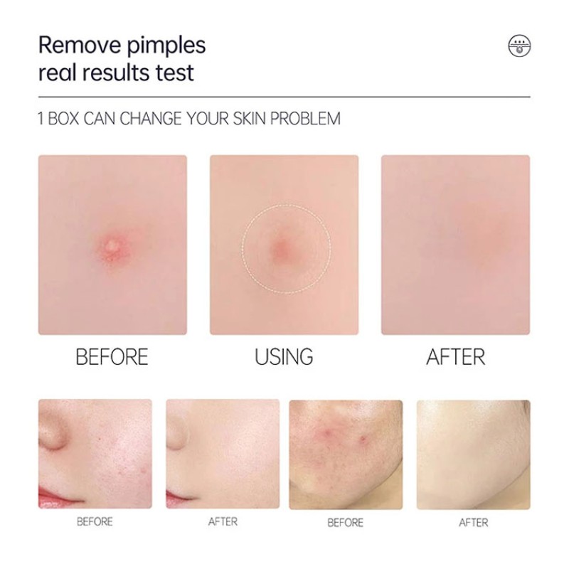 Acne Patch Manufacturer - Private Label Hydrocolloid Pimple Patch