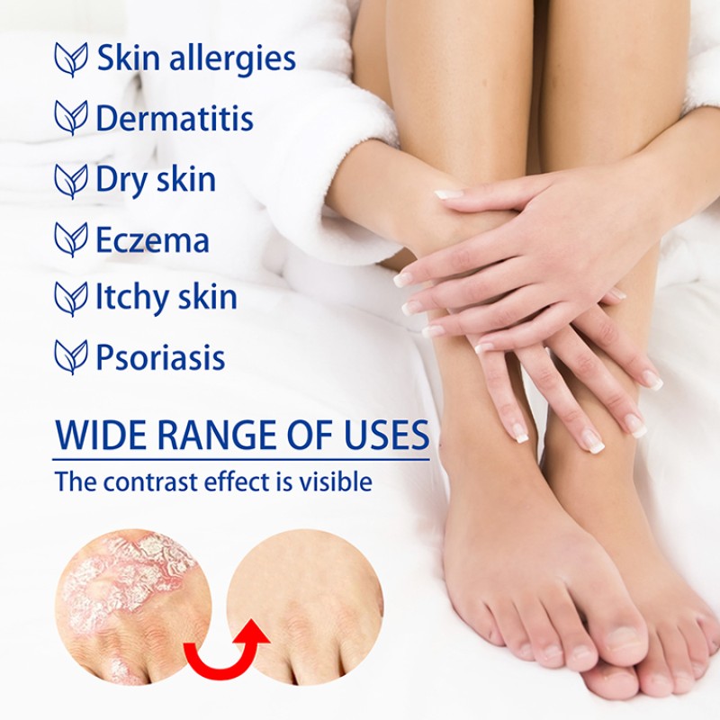 Jock Itch Relief Ointment Supplier - Wholesale Anti Itch Skin Cream