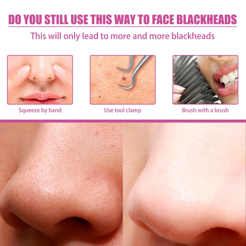 Blackhead Remover Supplier - Pores Cleaning Aloe Vera Treatment
