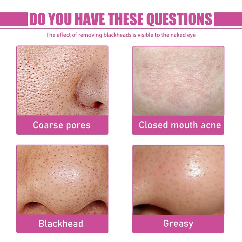 Blackhead Remover Supplier - Pores Cleaning Aloe Vera Treatment