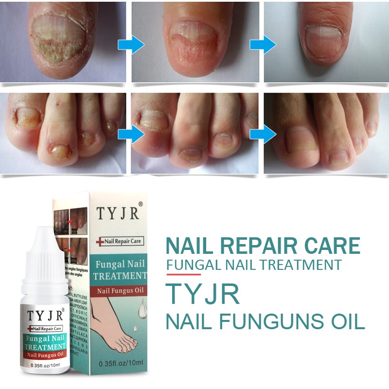Nail Care Oil Supplier - Onychomucosis Paronychia Treatment