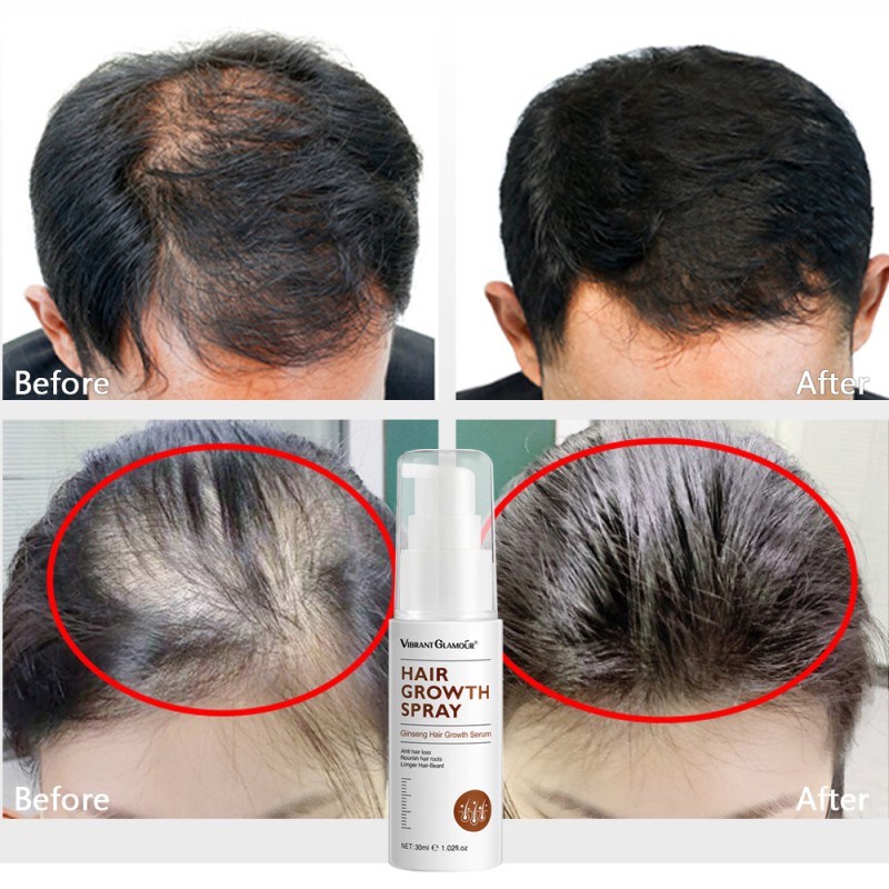 Hair Growth Serum Supplier - Ginseng Anti Hair Loss 30ml