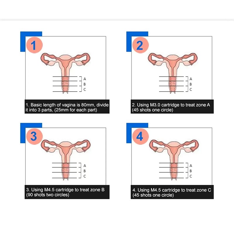 Vaginal Tightening Machine Supplier - Women Anti Aging Device