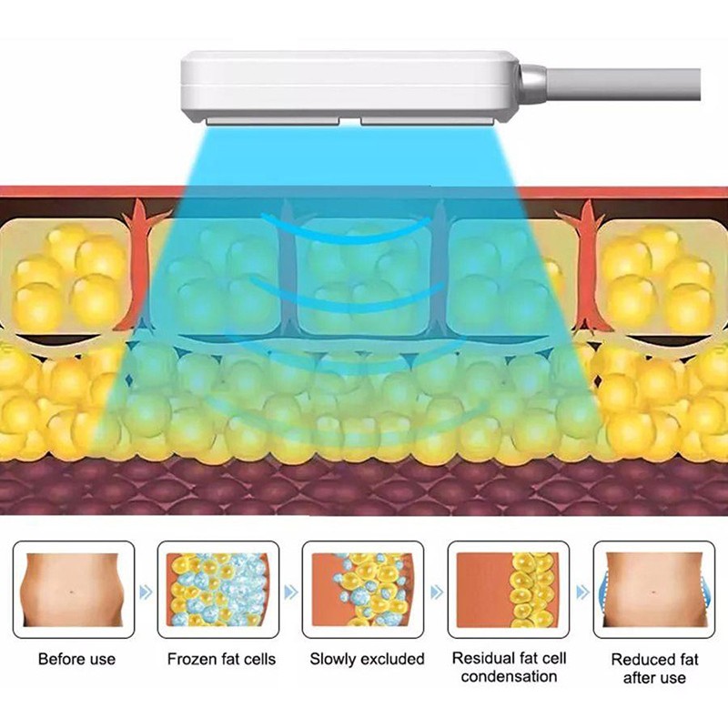 Cryoslimming Machine Supplier - EMS RF Fat Reduce