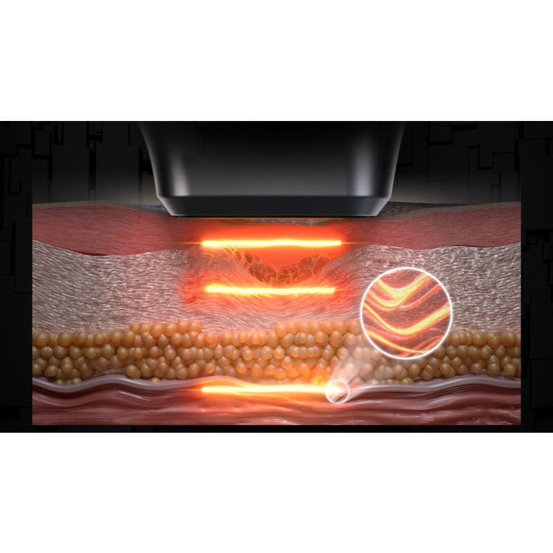 Beauty Machine Supplier - 12D MAX Face Lifting Device