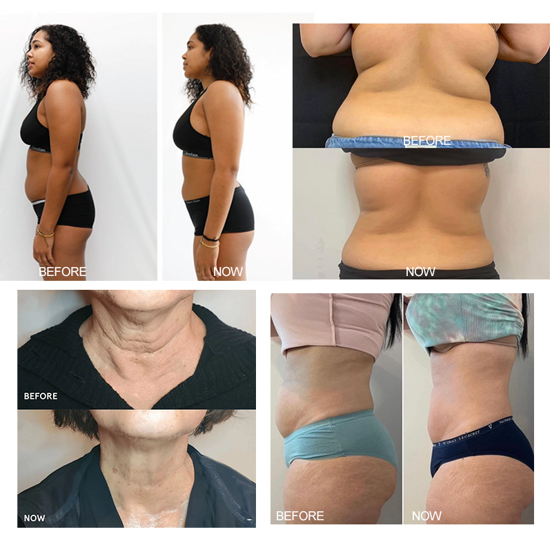 Cryoskin Machine Factory - 3in1 Thermal Cold Slimming