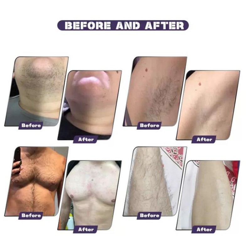 Laser Hair Removal Machine Supplier - Professional 755nm 808nm