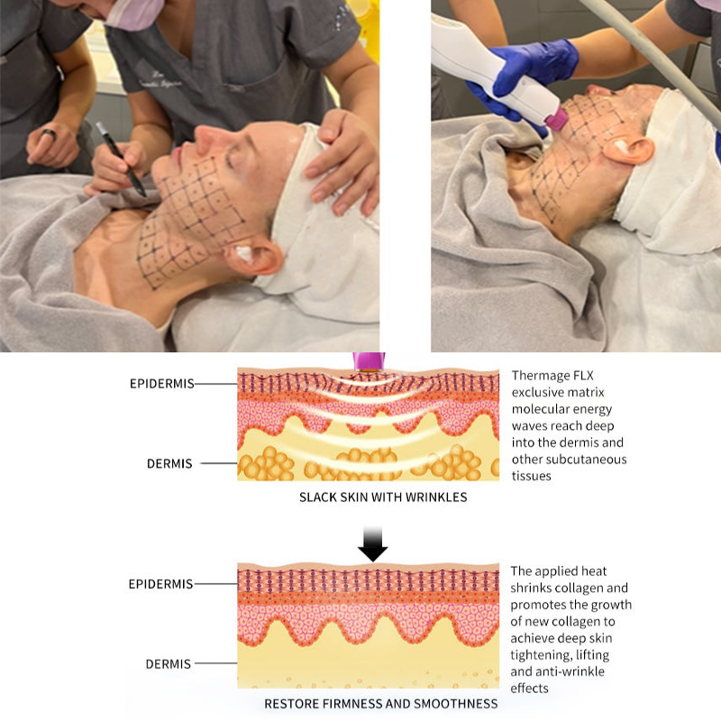 RF Facial Device Manufacturer - Monopolar Collagen Stimulation