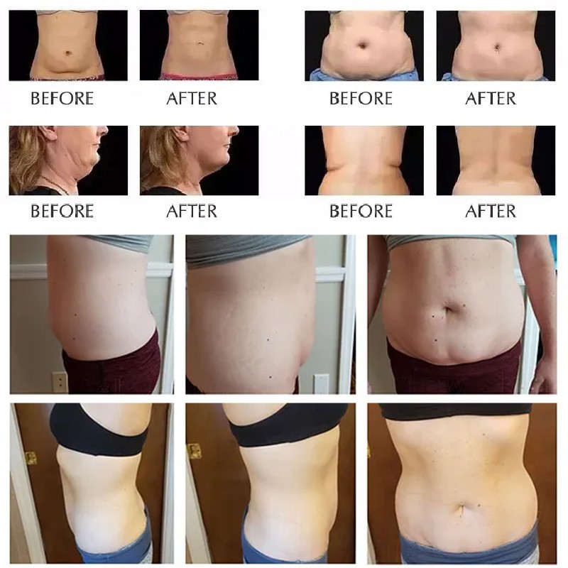 Slimming Machine Manufacturer - 80k RF Weight Loss