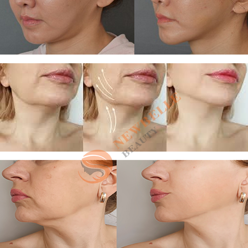 Face Massager Supplier - RF EMS Microcurrent Lift