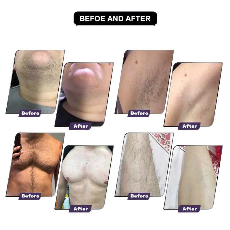 Diode Laser Machine Supplier - 3 Waves Fiber 808