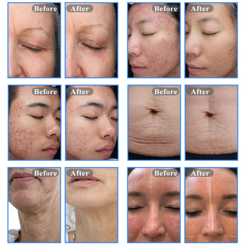 Thermo Mechanical Machine Manufacturer - Skin Resurfacing Device