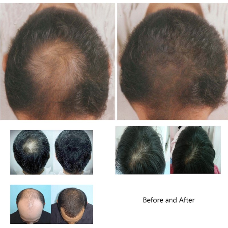 Hair Loss Machine Factory - Laser Regrowth System