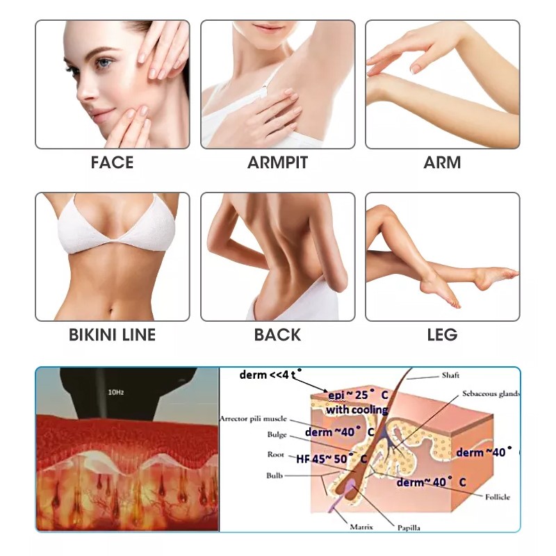 Laser Hair Removal Manufacturer - Alexan Ice Platinum