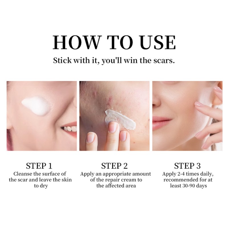 Scar Ointment Manufacturer - Fades Scar Stretch Marks Skin Care Cross-border