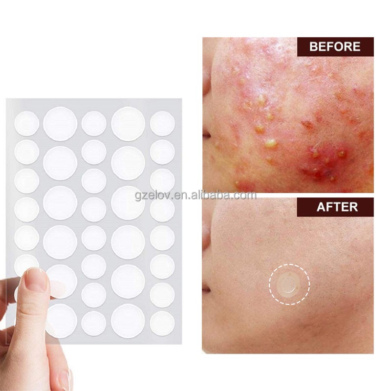 Acne Patch Manufacturer - Natural Plant Extract Waterproof