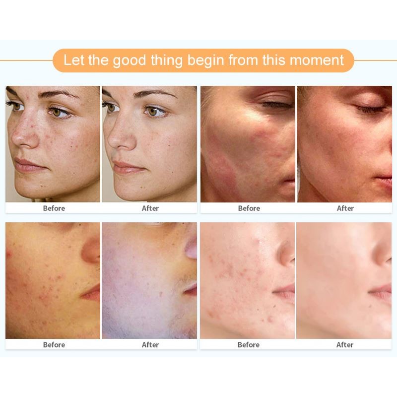 Sakura Mud Mask Supplier - Blackhead Removal Medical