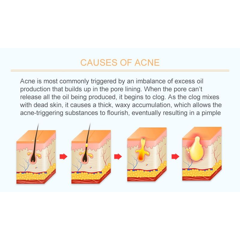 Sakura Mud Mask Supplier - Blackhead Removal Medical