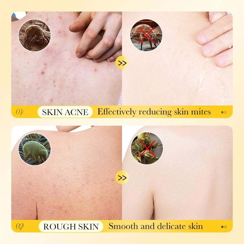 Shower Gel Supplier - Sulfur Anti-Acne Mite Removal Exfoliating Refreshing