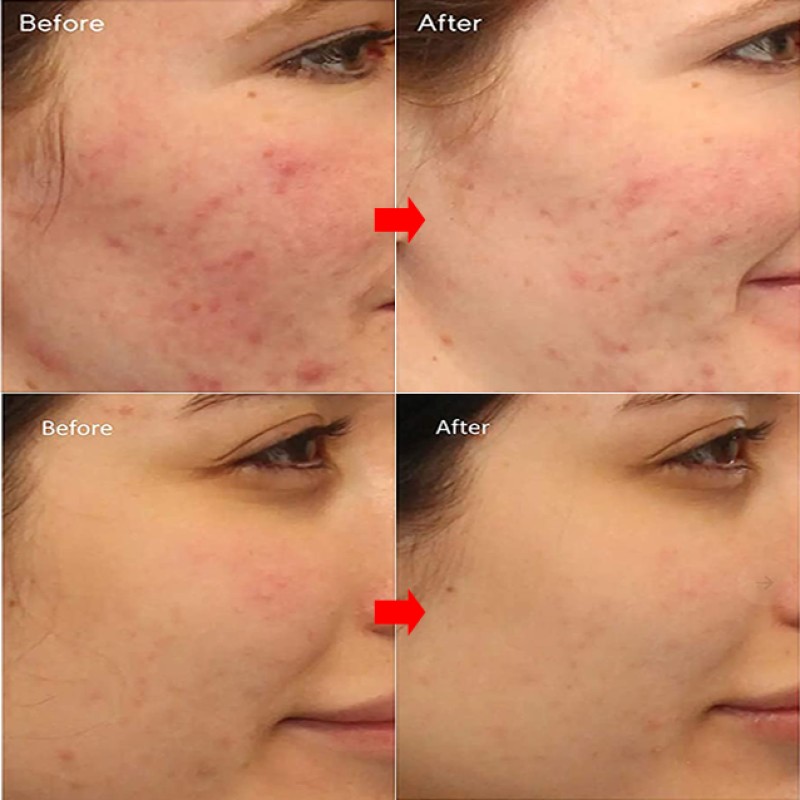 Face Cleanser Factory - Exfoliating Acne Treatment Niacinamide Amino Acid