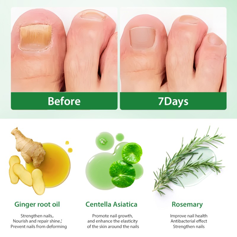 Nail Fungus Spray Factory - Private Label 2025 New 7 Days Damage Repair Cuticle Care