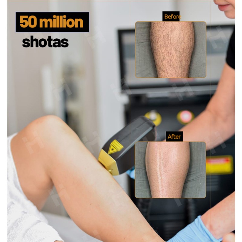 Diode Laser Machine Supplier - Ice Titanium 808nm Permanent 755nm 808 1064nm Professional