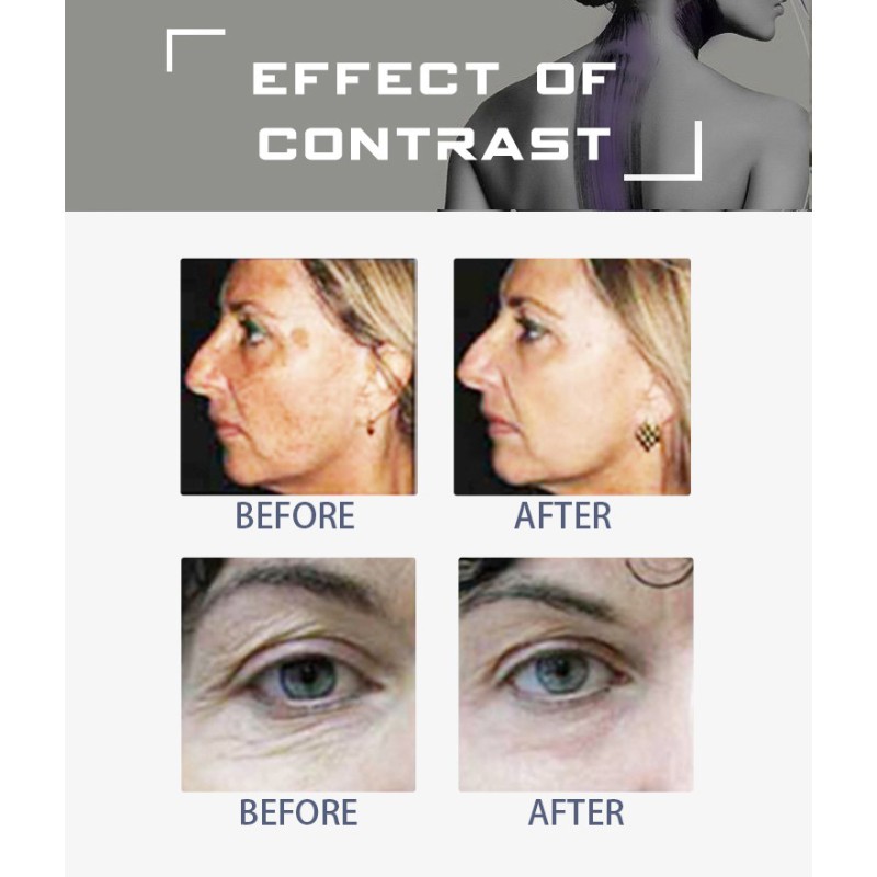 CO2 Laser Machine Manufacturer - Shandong Huamei New Wrinkle Removal Scar Removal Tighten Vagina