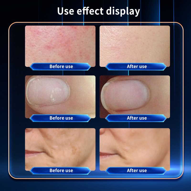 Diode Laser Factory - Huamei 980nm Physiotherapy Machine Nail Fungus Removal Veins Removal Laser