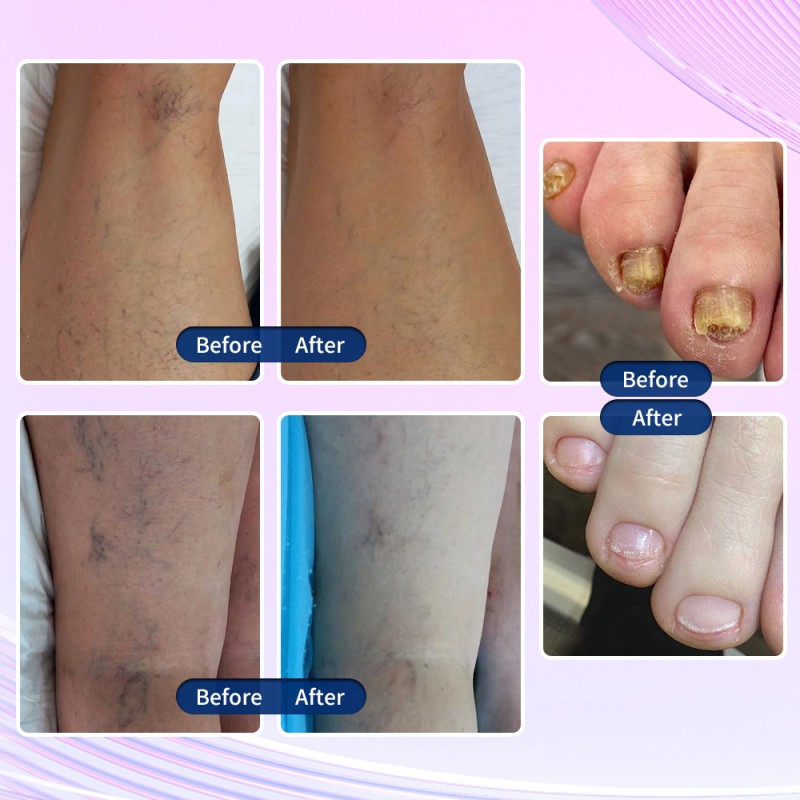 Diode Laser Manufacturer - 2025 Hot Selling 980nm CE TUV ISO13485 4 in 1 Physiotherapy Machine