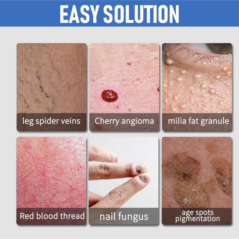 Cryo Skin Cooling Factory - Ice Cooling Skin Portable Skin Cooling Machine