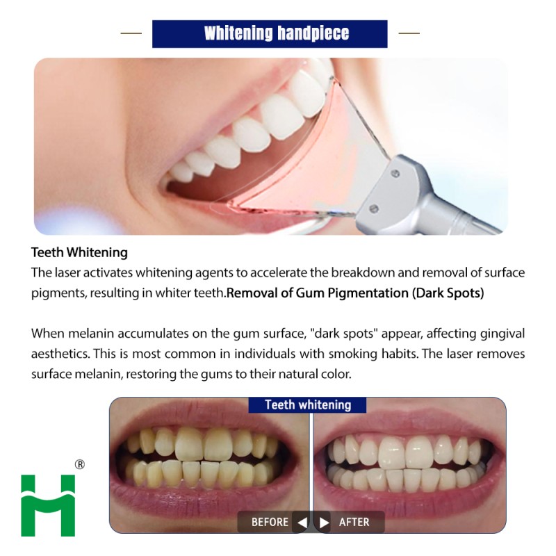 Dental Laser Machine Supplier - Multifunction 980nm Dental Surgery Diode Laser