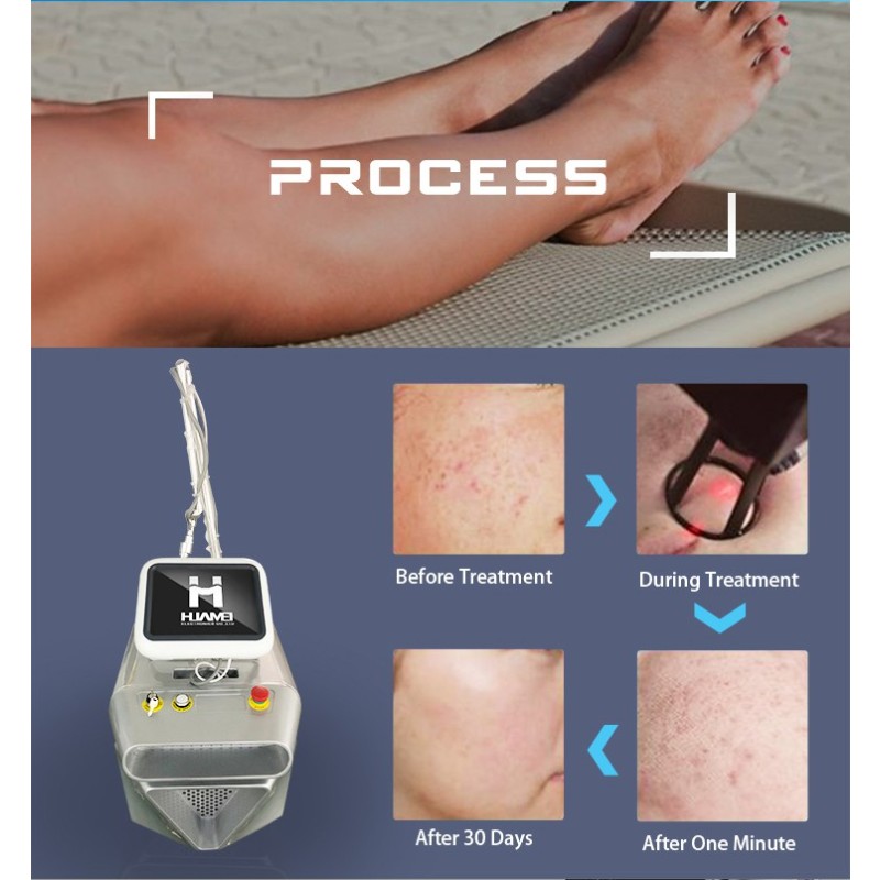 CO2 Laser Machine Factory - 2025 Newest Female Private Therapy Vagina Tightening Portable