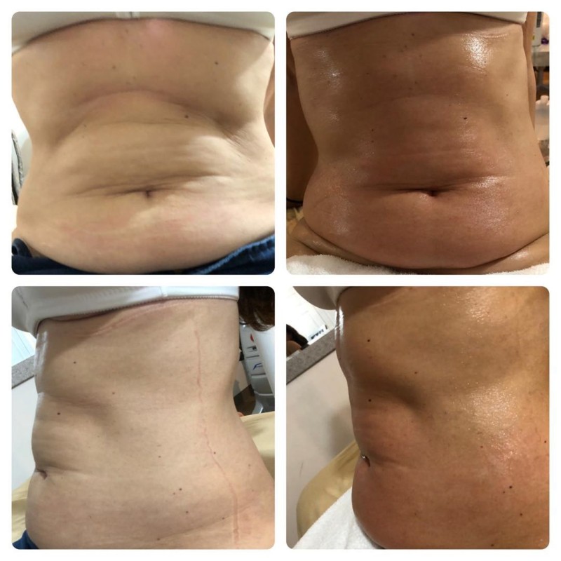 RF Skin Tightening Supplier - Anti-wrinkle Professional RF Device for Face Lifting Beauty Body Shaping