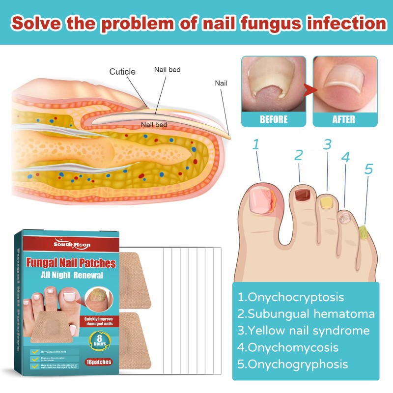 Nail Patches Supplier - Nail Treatment 8 Hours Fast Effective Fungal Nail Repair Patches Improvement