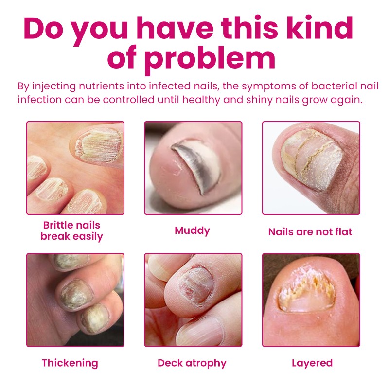 Nail Serum Supplier - Nail Treatment Fungal Nail Repair Rough Promote Growth Ginger Liquid Serum