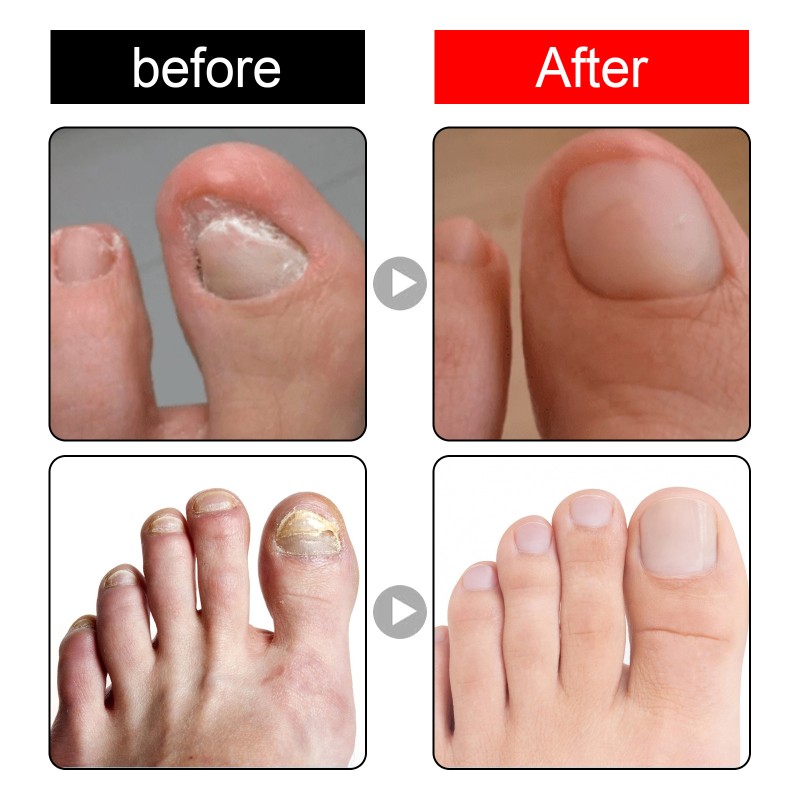 Toenail Corrector Factory - Cuticle Care Oils Strengthen In-growing Toe Nail Corrector Repair Drops