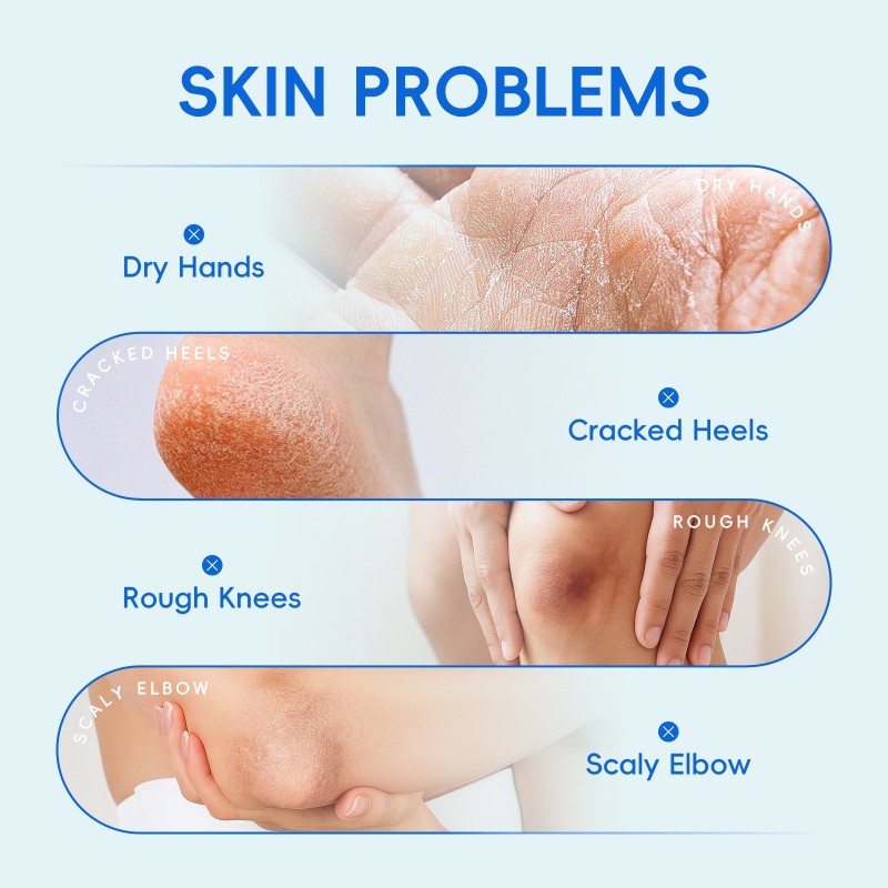 Foot Cream Supplier - Urea Cream Hydrating Foot Cream Moisturizing Rough Hand Soften Exfoliate
