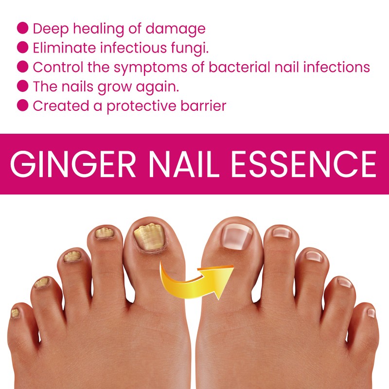 Nail Serum Supplier - Nail Treatment Fungal Nail Repair Rough Promote Growth Ginger Liquid Serum