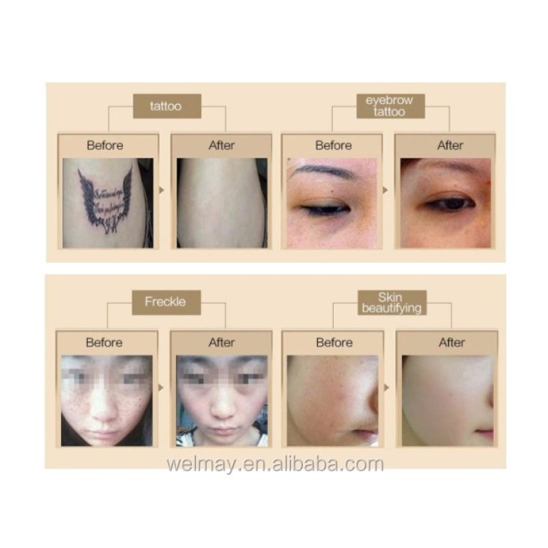 Picosecond Laser Machine Supplier - Advanced Skin Whitening Nd Yag Picosecond Tattoo Removal