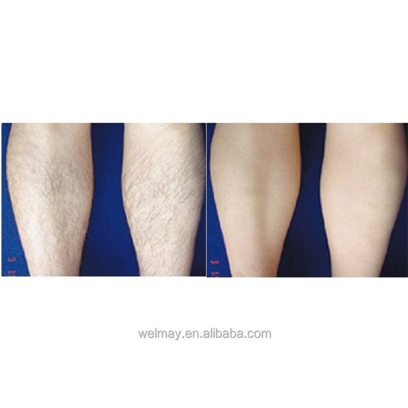 Laser Hair Removal Machine Manufacturer - High Power Professional 755 808 1064nm Diode Laser Spa