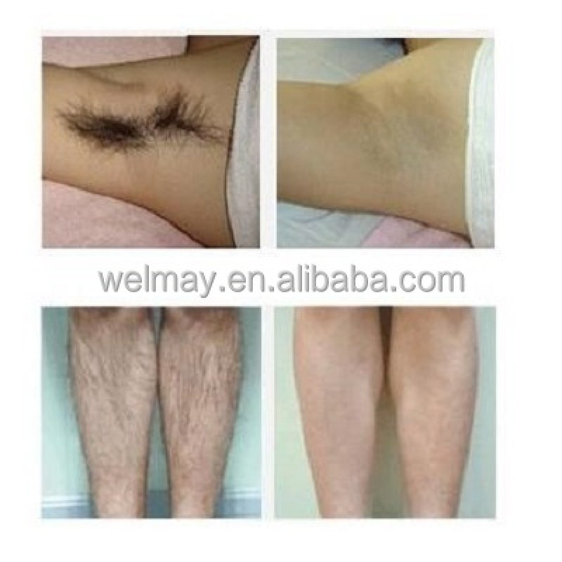 Nd Yag Laser Machine Supplier - Hot Sale Portable Q Switched Skin Tightening IPL Beauty Equipment