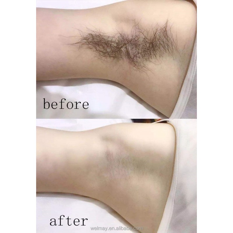 Professional Diode Laser Factory - 755nm 808nm 1064nm 4 Wave Hair Removal Diodo Lazer Equipment