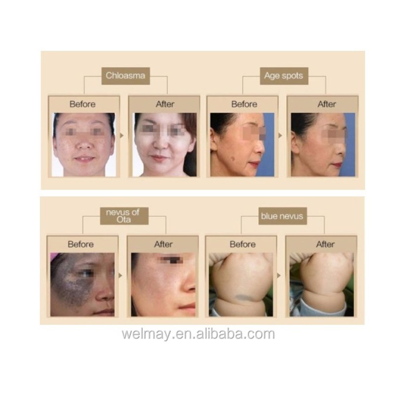 Picosecond Laser Machine Supplier - Advanced Skin Whitening Nd Yag Picosecond Tattoo Removal