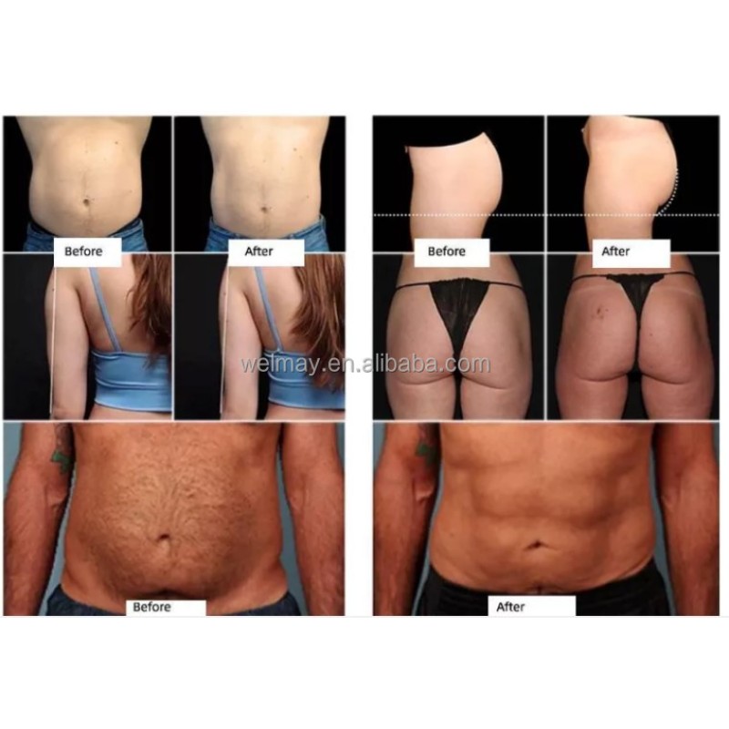 Home Cavitation Machine Supplier - Newest Handheld Home Use 40K Cavitation Slimming LED Photon